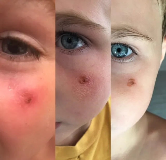 Natural Remedy for Staph/Impetigo