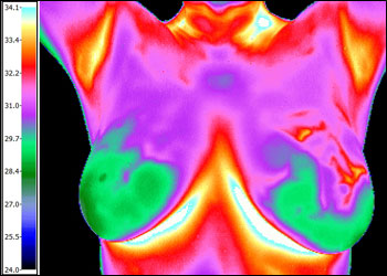 Image of breast tissue from Thermascan